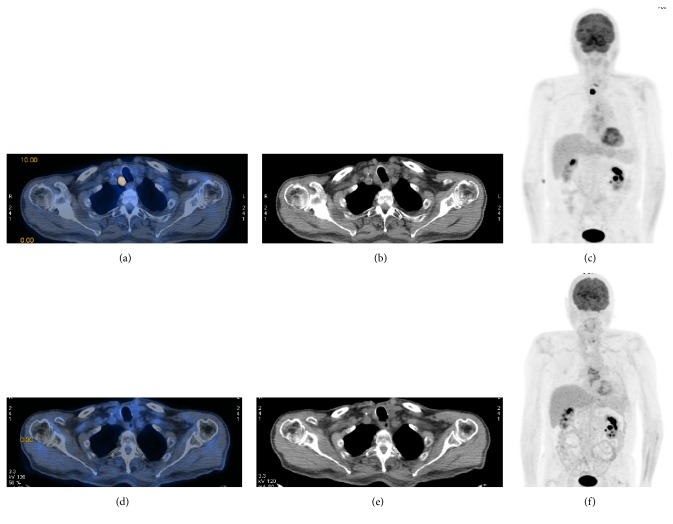 <sup>18</sup>F-FDG Pet-Guided External Beam Radiotherapy in Iodine-Refractory Differentiated Thyroid Cancer: A Pilot Study.