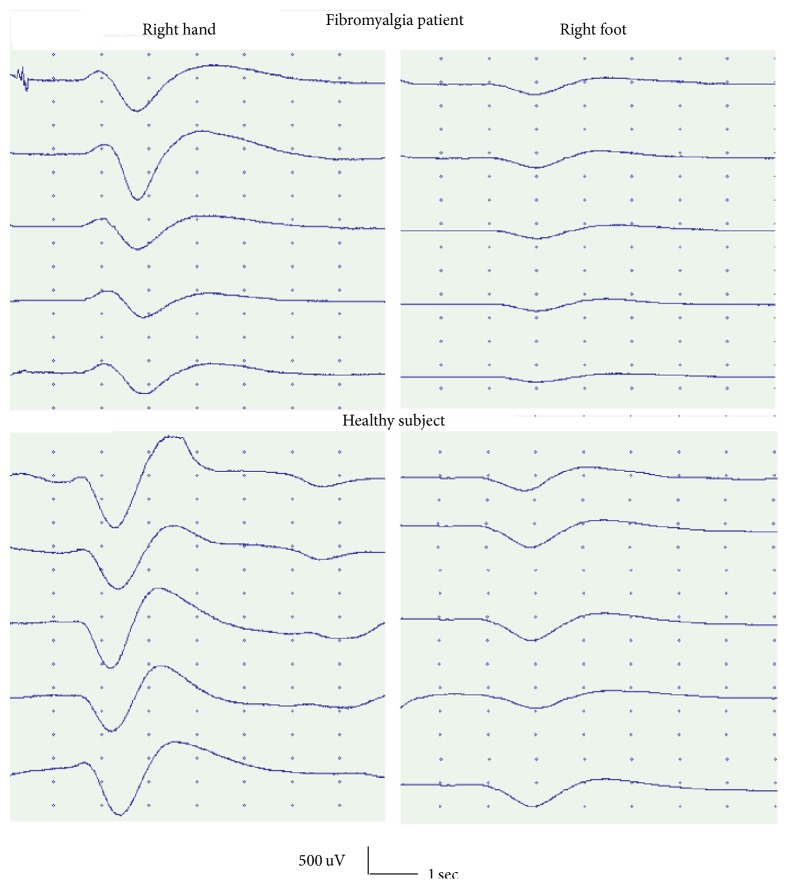 Pain Processing and Vegetative Dysfunction in Fibromyalgia: A Study by Sympathetic Skin Response and Laser Evoked Potentials.