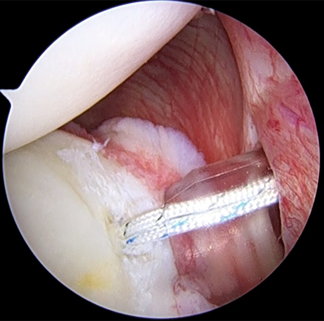 Soft tissue-based surgical techniques for treatment of posterior shoulder instability.
