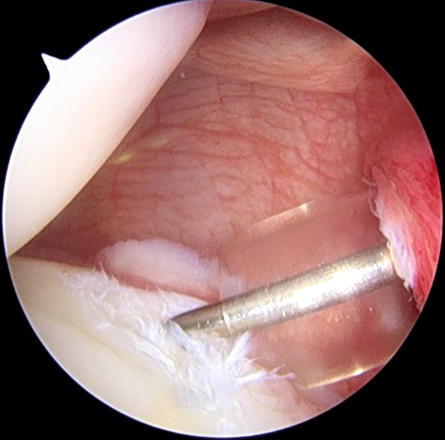 Soft tissue-based surgical techniques for treatment of posterior shoulder instability.