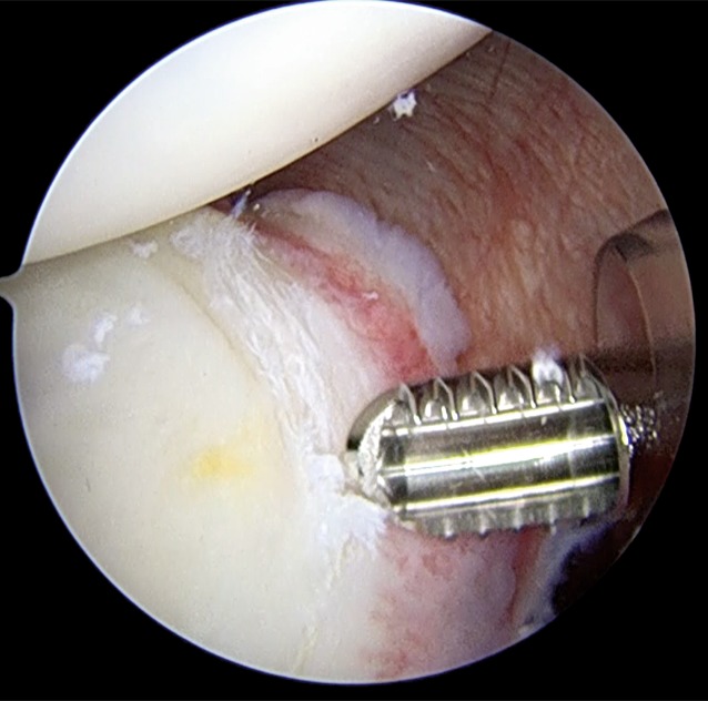 Soft tissue-based surgical techniques for treatment of posterior shoulder instability.