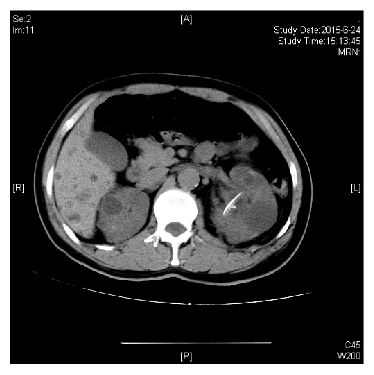 Percutaneous Nephrolithotomy under Ultrasound Guidance in Patients with Renal Calculi and Autosomal Dominant Polycystic Kidney Disease: A Report of 11 Cases.