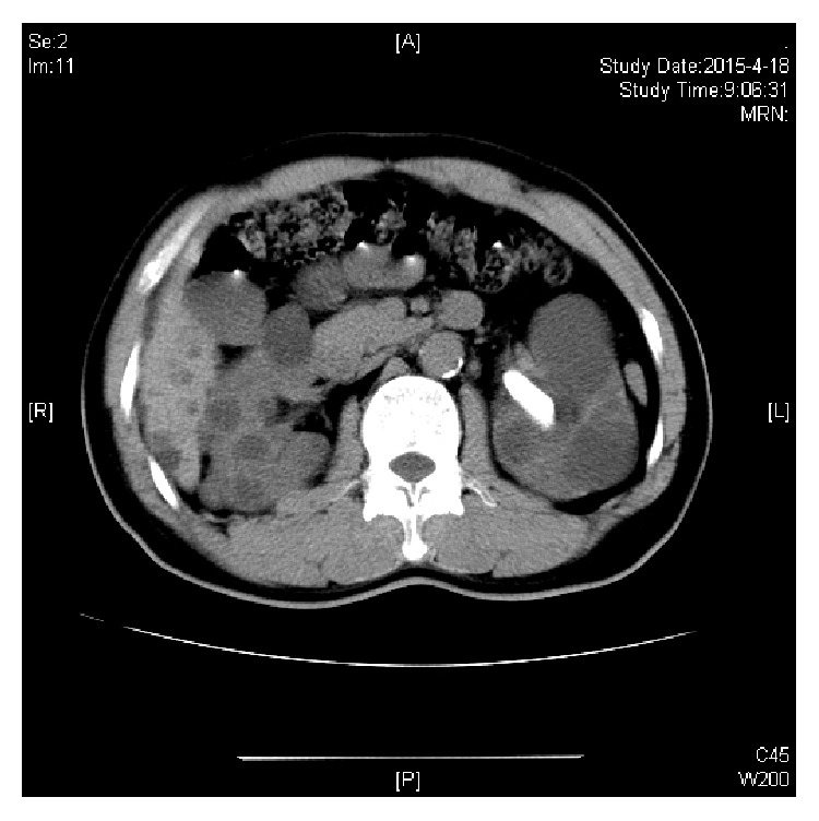 Percutaneous Nephrolithotomy under Ultrasound Guidance in Patients with Renal Calculi and Autosomal Dominant Polycystic Kidney Disease: A Report of 11 Cases.