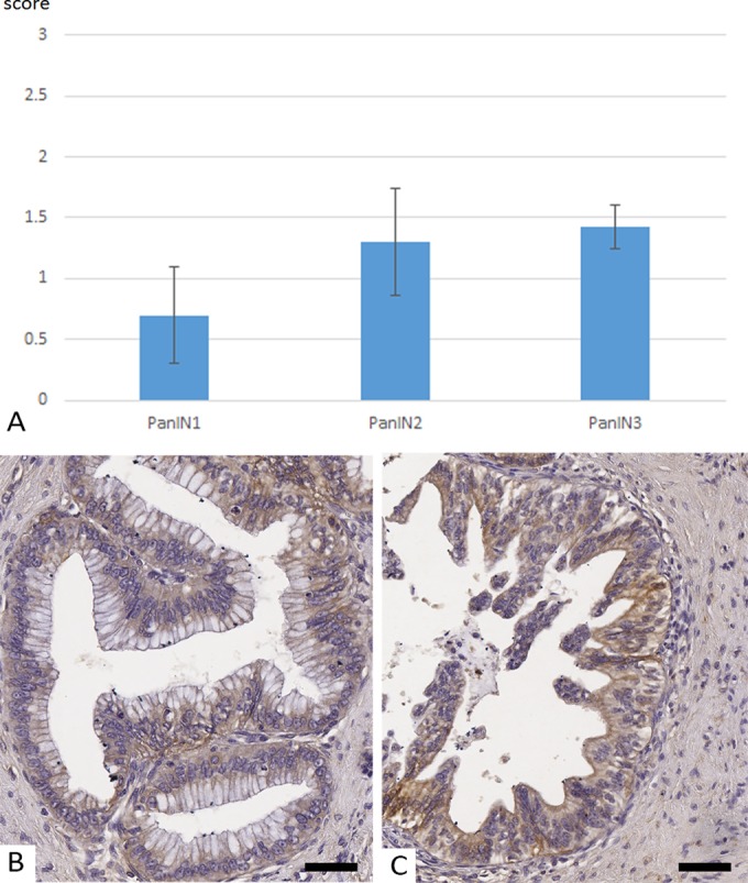 Perspective of αvβ6-Integrin Imaging for Clinical Management of Pancreatic Carcinoma and Its Precursor Lesions.