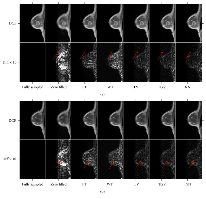 Quantitative Evaluation of Temporal Regularizers in Compressed Sensing Dynamic Contrast Enhanced MRI of the Breast.