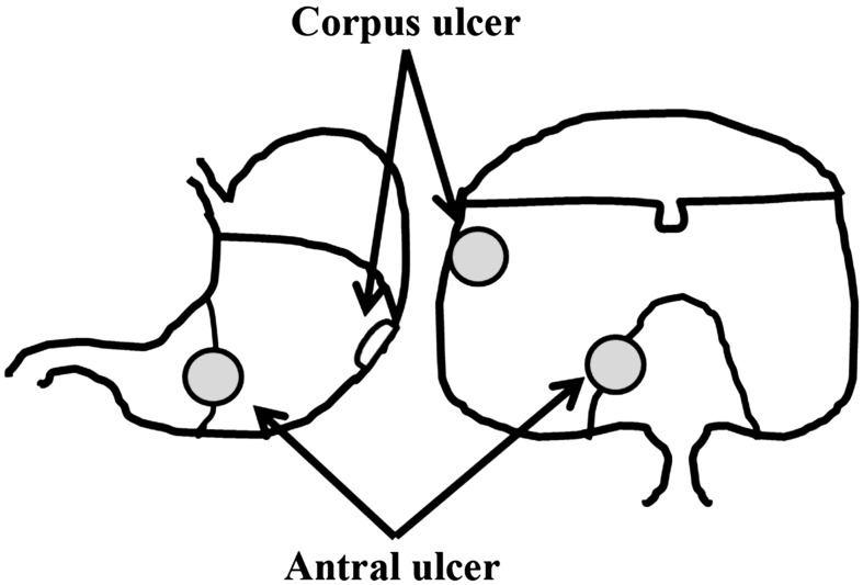 Gastric emptying after artificial ulceration in rats: differences due to the site of the ulcer and the effects of prokinetic drugs.