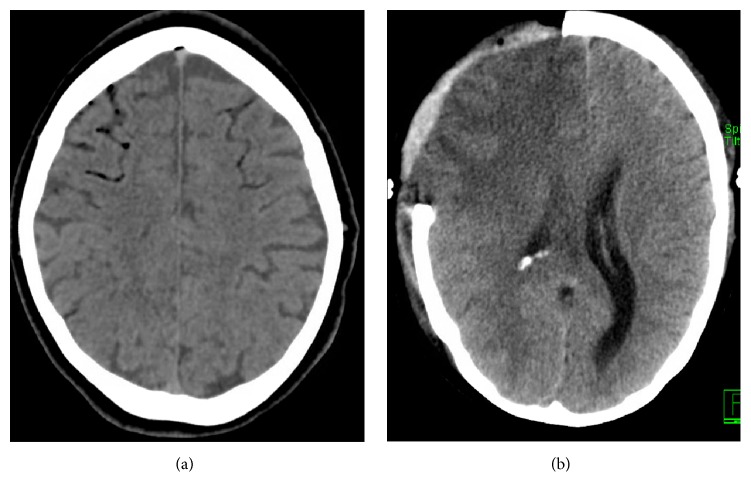 A Systematic Review of the Causes and Management of Ischaemic Stroke Caused by Nontissue Emboli.