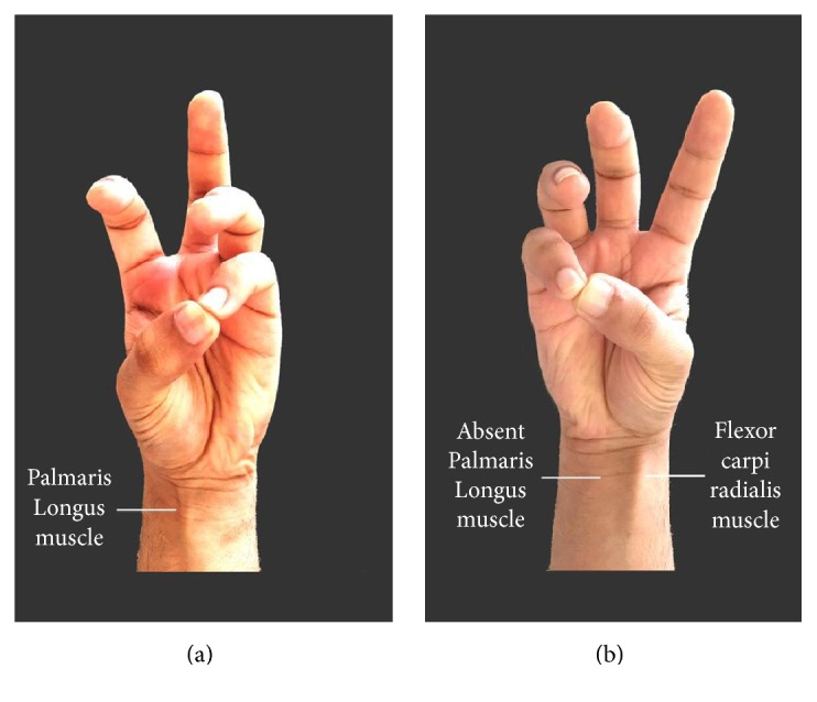 Clinical Assessment of the Congenital Absence of Palmaris Longus and Flexor Digitorum Superficialis Muscles in Young Saudi Population.
