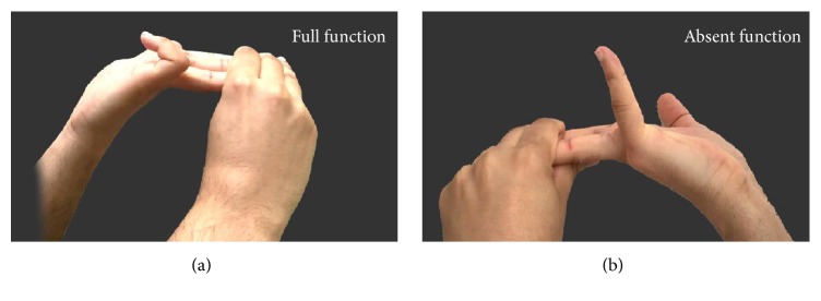 Clinical Assessment of the Congenital Absence of Palmaris Longus and Flexor Digitorum Superficialis Muscles in Young Saudi Population.