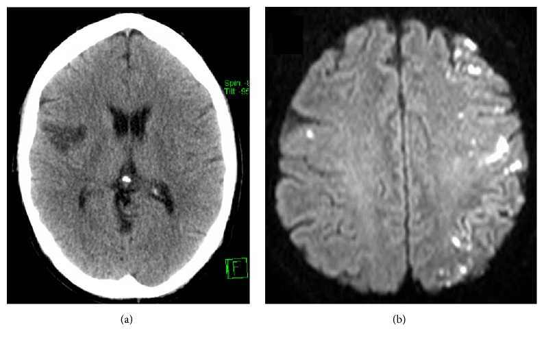 A Systematic Review of the Causes and Management of Ischaemic Stroke Caused by Nontissue Emboli.