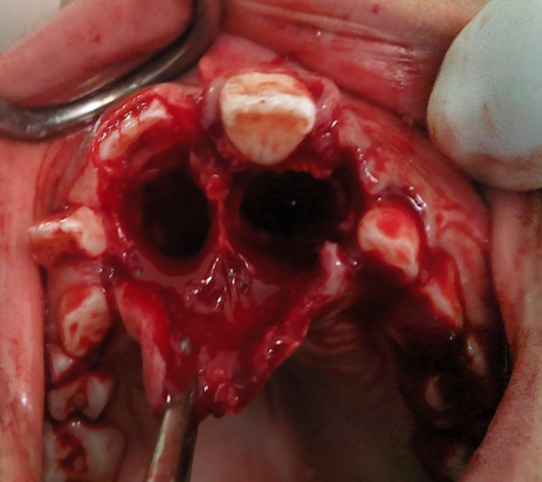 Bilateral molariform supernumerary teeth in the anterior maxilla: a report of two cases.