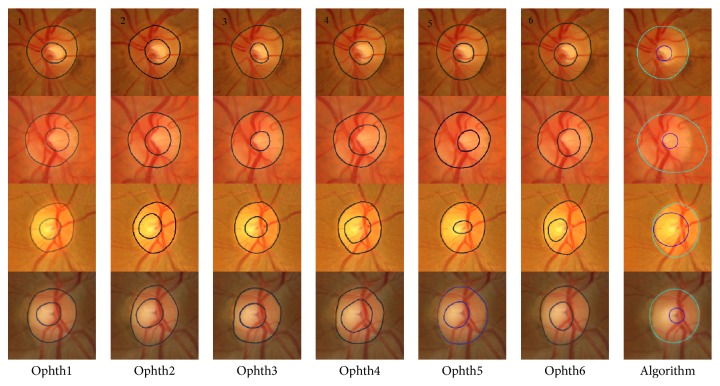 An Automatic Image Processing System for Glaucoma Screening.