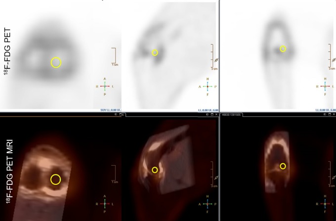 Preclinical Multimodal Molecular Imaging Using <sup>18</sup>F-FDG PET/CT and MRI in a Phase I Study of a Knee Osteoarthritis in In Vivo Canine Model.