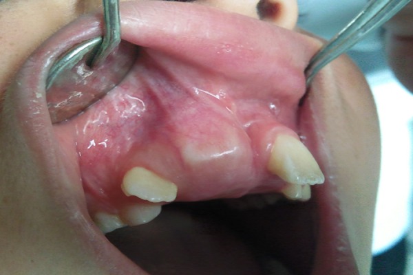 Bilateral molariform supernumerary teeth in the anterior maxilla: a report of two cases.