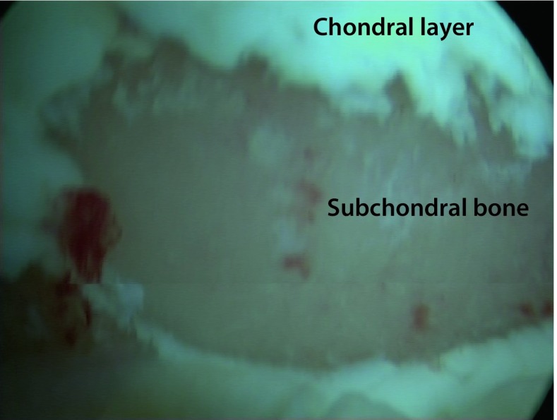 Chondral defects of the glenohumeral joint: Long-term outcome after microfracturing of the shoulder.