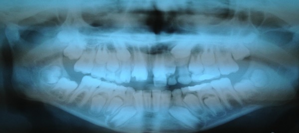 Bilateral molariform supernumerary teeth in the anterior maxilla: a report of two cases.