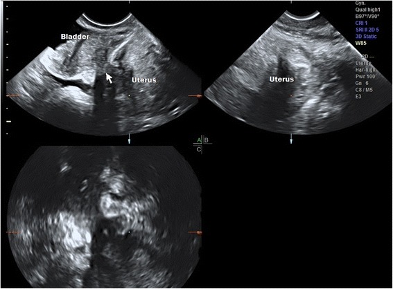 Applying a statistical method in transvaginal ultrasound training: lessons from the learning curve cumulative summation test (LC-CUSUM) for endometriosis mapping.