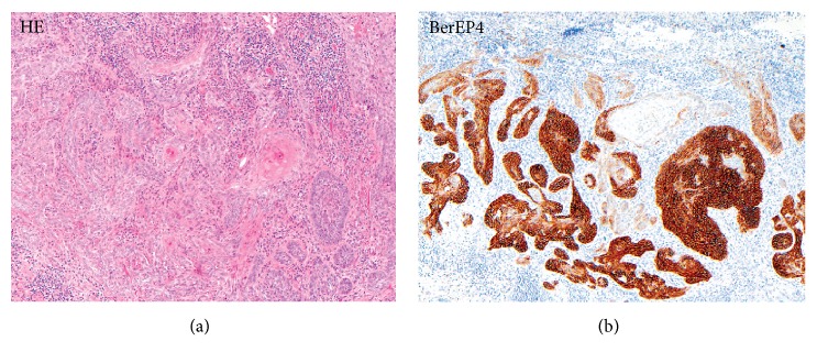 The Use of BEREP4 Immunohistochemistry Staining for Detection of Basal Cell Carcinoma.