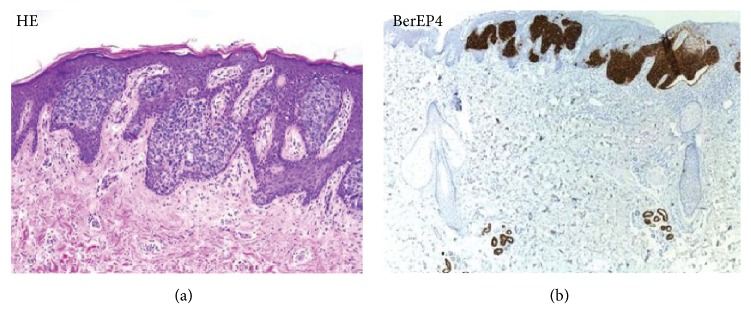 The Use of BEREP4 Immunohistochemistry Staining for Detection of Basal Cell Carcinoma.