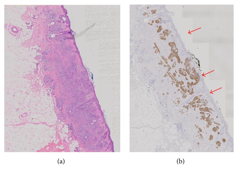 The Use of BEREP4 Immunohistochemistry Staining for Detection of Basal Cell Carcinoma.