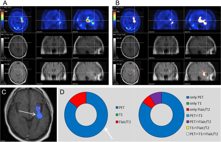 Multimodal Imaging of Patients With Gliomas Confirms <sup>11</sup>C-MET PET as a Complementary Marker to MRI for Noninvasive Tumor Grading and Intraindividual Follow-Up After Therapy.