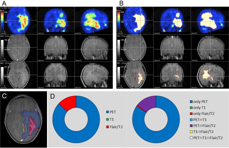 Multimodal Imaging of Patients With Gliomas Confirms <sup>11</sup>C-MET PET as a Complementary Marker to MRI for Noninvasive Tumor Grading and Intraindividual Follow-Up After Therapy.