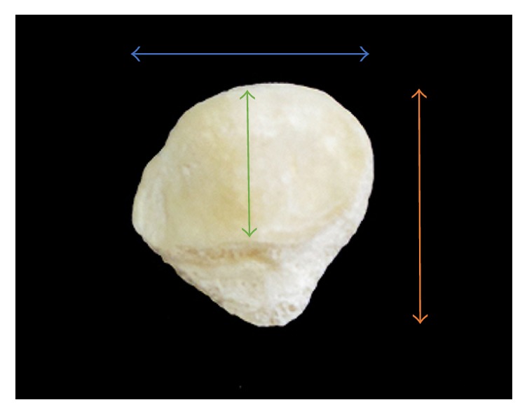 Surface Area of Patellar Facets: Inferential Statistics in the Iraqi Population.