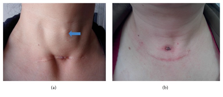 Clinical Study on the Etiology of Postthyroidectomy Skin Sinus Formation.