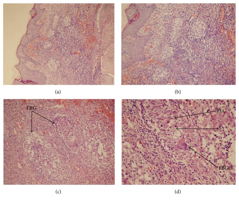 Clinical Study on the Etiology of Postthyroidectomy Skin Sinus Formation.