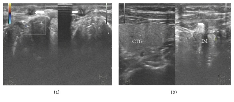 Clinical Study on the Etiology of Postthyroidectomy Skin Sinus Formation.