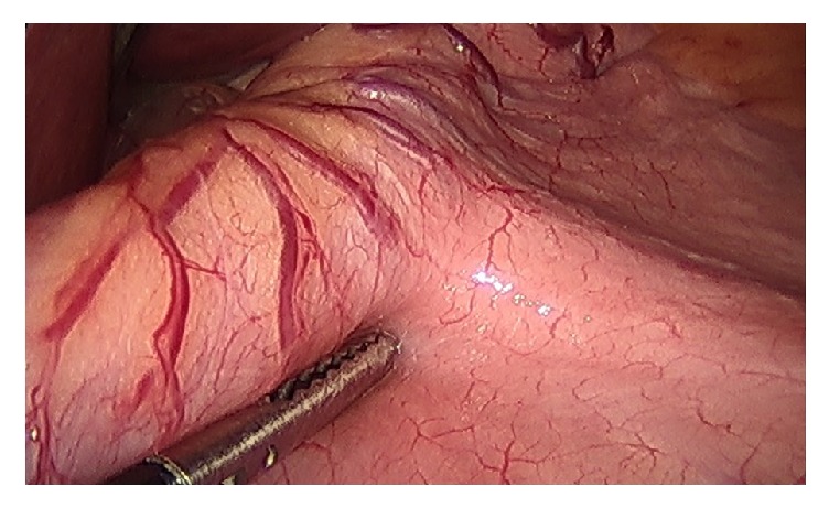 Technical Details of Laparoscopic Sleeve Gastrectomy Leading to Lowered Leak Rate: Discussion of 1070 Consecutive Cases.