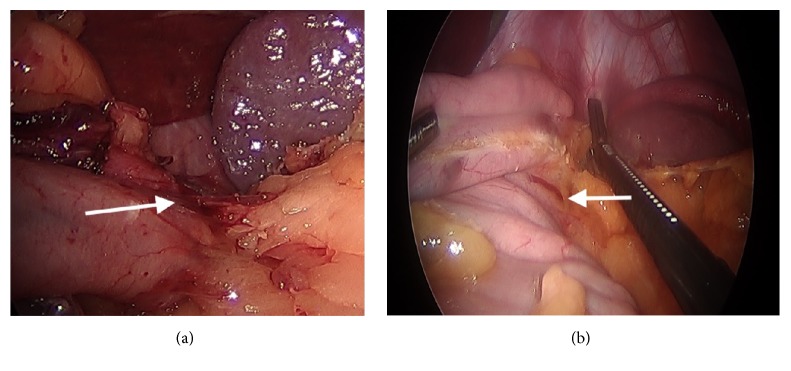 Technical Details of Laparoscopic Sleeve Gastrectomy Leading to Lowered Leak Rate: Discussion of 1070 Consecutive Cases.