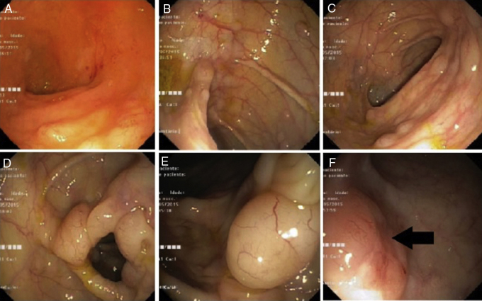 Mantle cell lymphoma presenting as multiple lymphomatous polyposis of the gastrointestinal tract