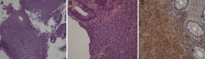 Mantle cell lymphoma presenting as multiple lymphomatous polyposis of the gastrointestinal tract