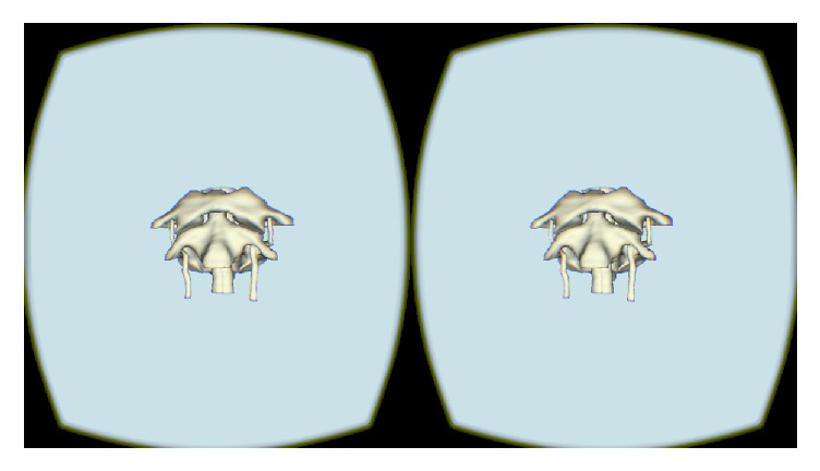 Stereopsis, Visuospatial Ability, and Virtual Reality in Anatomy Learning.