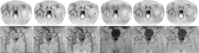 Effect of Time-of-Flight and Regularized Reconstructions on Quantitative Measurements and Qualitative Assessments in Newly Diagnosed Prostate Cancer With <sup>18</sup>F-Fluorocholine Dual Time Point PET/MRI.