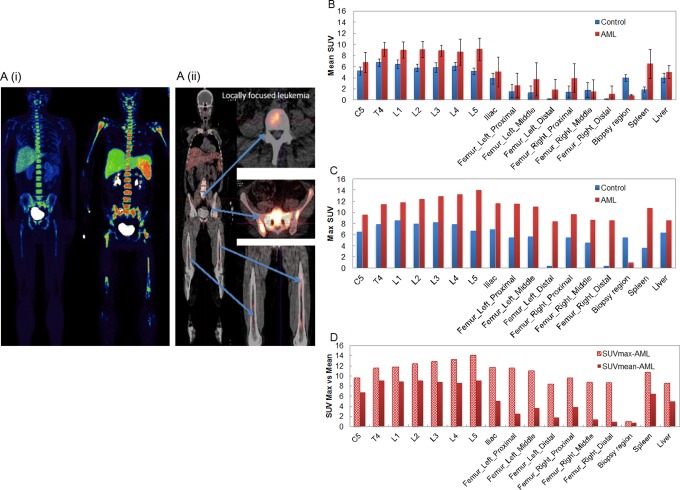 Whole-Body Distribution of Leukemia and Functional Total Marrow Irradiation Based on FLT-PET and Dual-Energy CT.