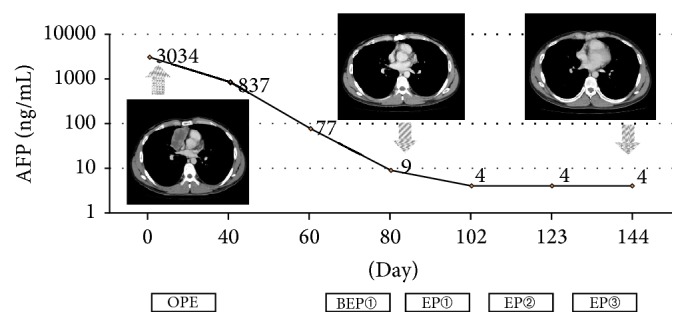 A Study of Patients with Primary Mediastinal Germ Cell Tumors Treated Using Multimodal Therapy.