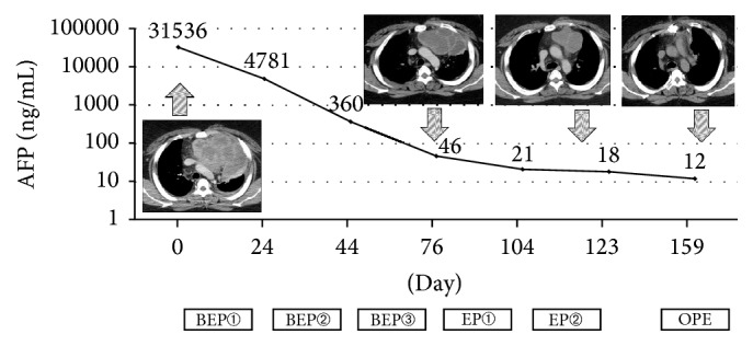 A Study of Patients with Primary Mediastinal Germ Cell Tumors Treated Using Multimodal Therapy.