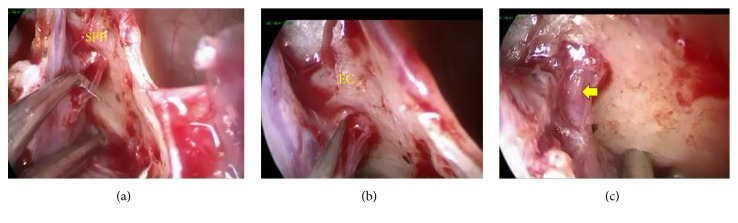 Management of Intractable Nasal Hyperreactivity by Selective Resection of Posterior Nasal Nerve Branches.