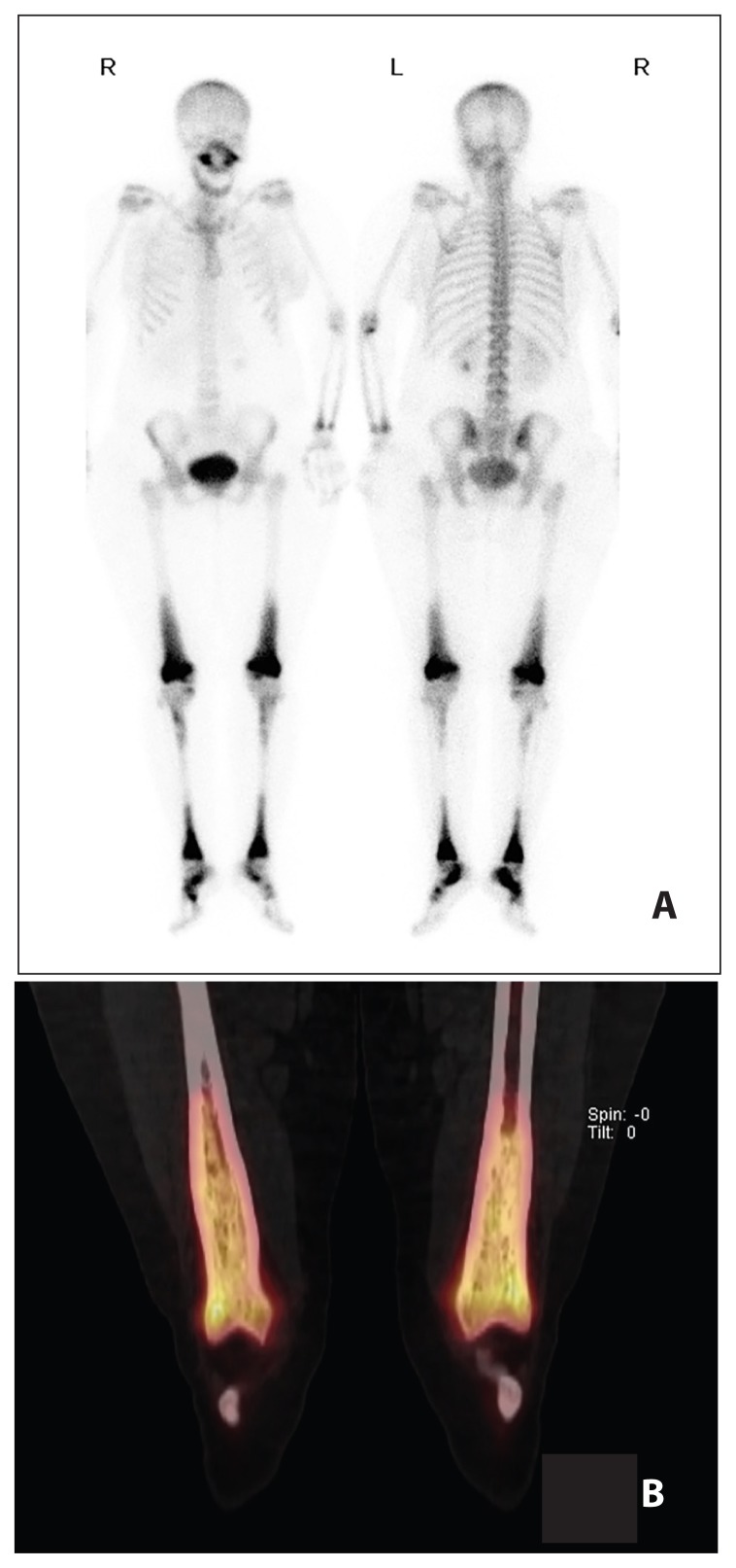 A rare case of Erdheim-Chester disease in the breast.