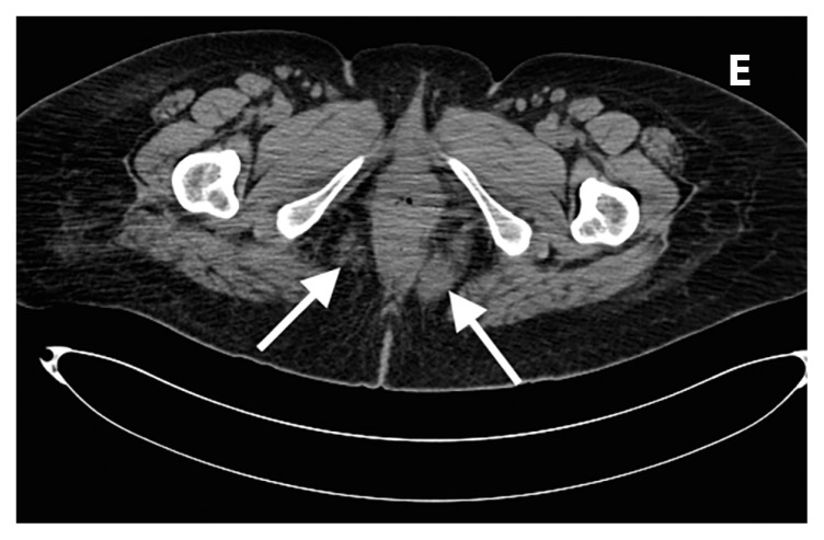 A rare case of Erdheim-Chester disease in the breast.