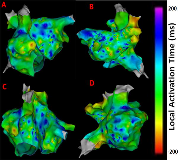 Novel approaches for quantitative electrogram analysis for intraprocedural guidance for catheter ablation: A case of a patient with persistent atrial fibrillation.