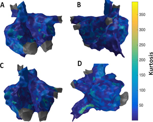 Novel approaches for quantitative electrogram analysis for intraprocedural guidance for catheter ablation: A case of a patient with persistent atrial fibrillation.