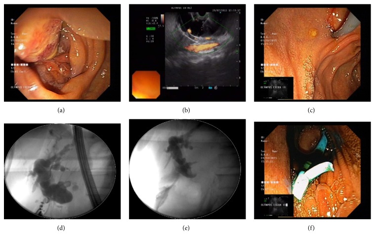 The Role of EUS-BD in the Management of Malignant Biliary Obstruction: The Indonesian Perspective.