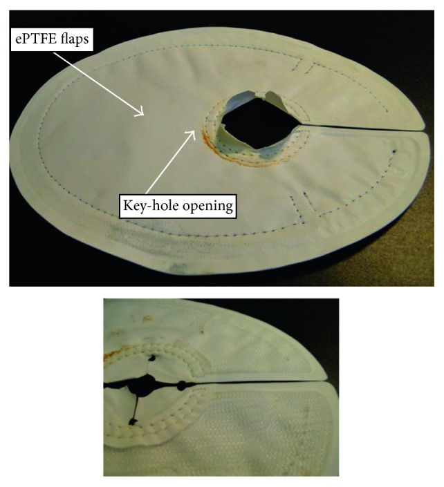 Parastomal Hernia Repair with Intraperitoneal Mesh.