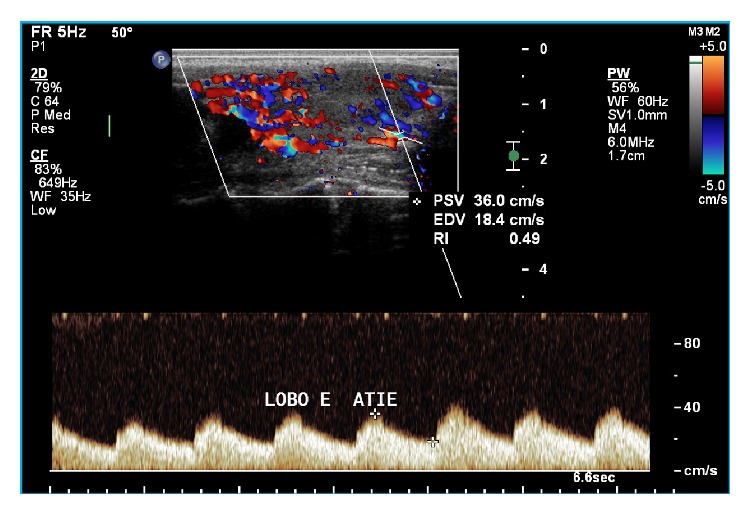 The End-Diastolic Velocity of Thyroid Arteries Is Strongly Correlated with the Peak Systolic Velocity and Gland Volume in Patients with Autoimmune Thyroiditis.