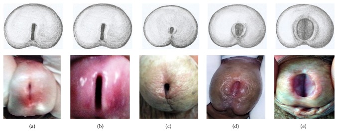 Impact Assessment of Urethral Meatus Morphology and Penile Biometry in Transurethral Prostate and Bladder Surgery.