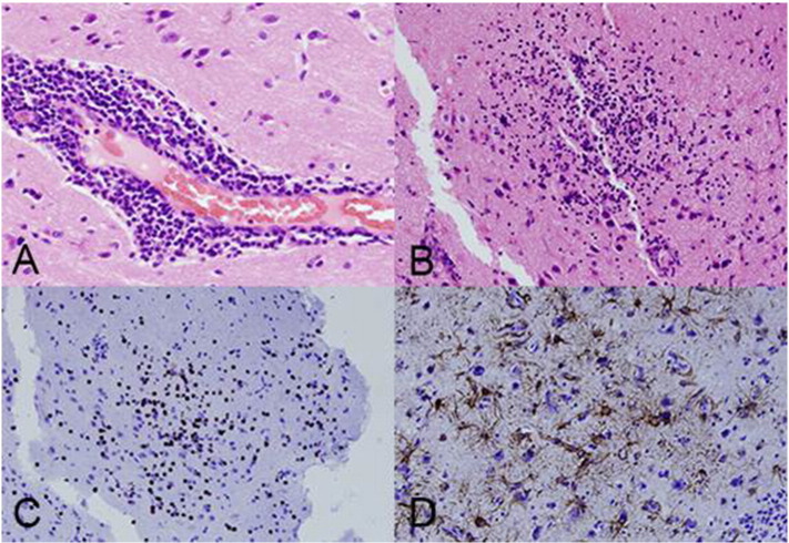 Functional hemispherotomy in Rasmussen syndrome in the absence of classic MRI findings