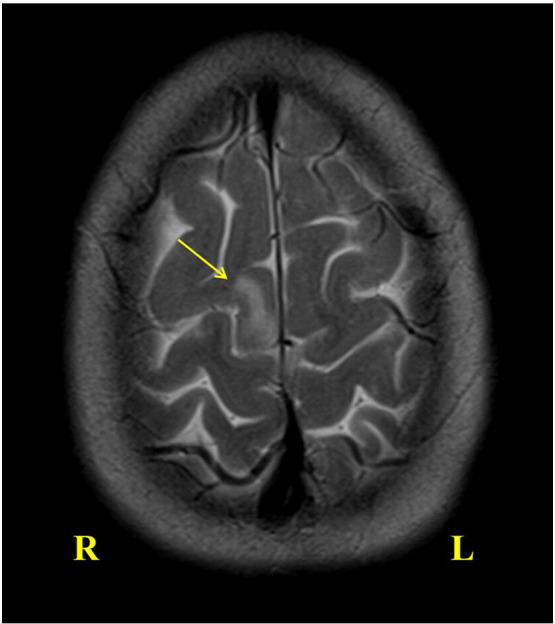 Functional hemispherotomy in Rasmussen syndrome in the absence of classic MRI findings